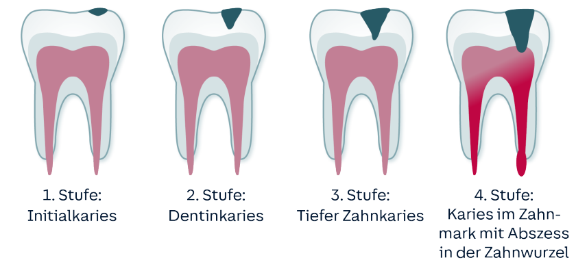 Anfangsstadium Wie Sieht Karies An Milchzähnen Aus Karies vorbeugen und behandeln