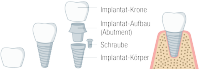 Grafik Zahnimplantat
